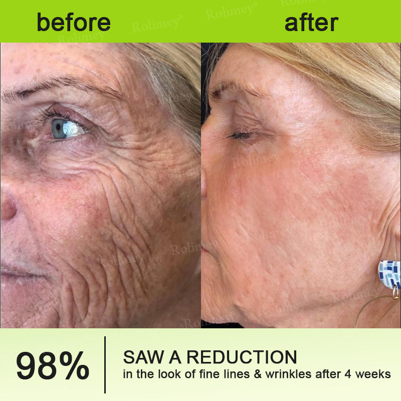 👨‍⚕️💛Made and shipped from South Africa💫Rolimey® Botox & Vita-A Retinol Shot Wrinkle-Lift Tightening cream - Last Day Promotion 70% OFF