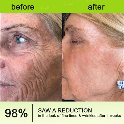 👨‍⚕️💛Made and shipped from South Africa💫Rolimey® Botox & Vita-A Retinol Shot Wrinkle-Lift Tightening cream - Last Day Promotion 70% OFF