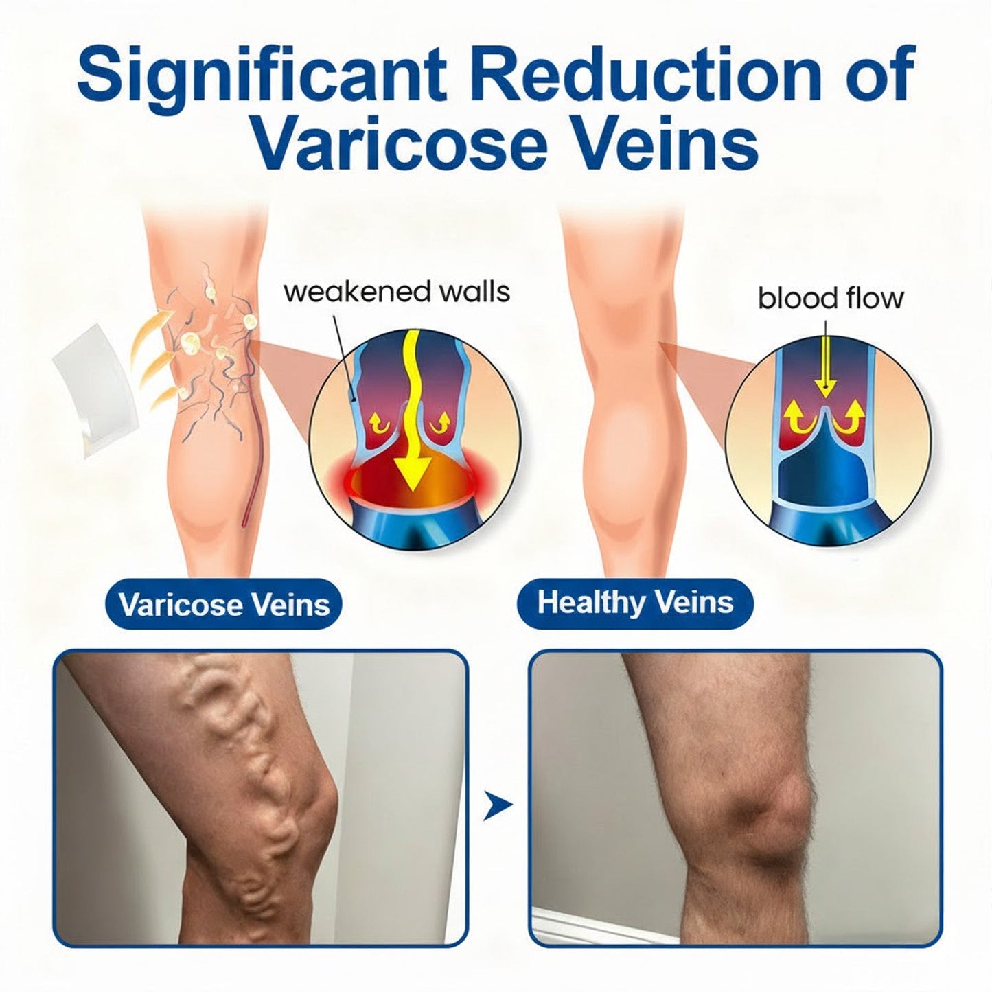 🇿🇦👨‍⚕️📌GFOUK® VeinEase Microneedle Care Patch⚡Instant Relief, Long-Term Results