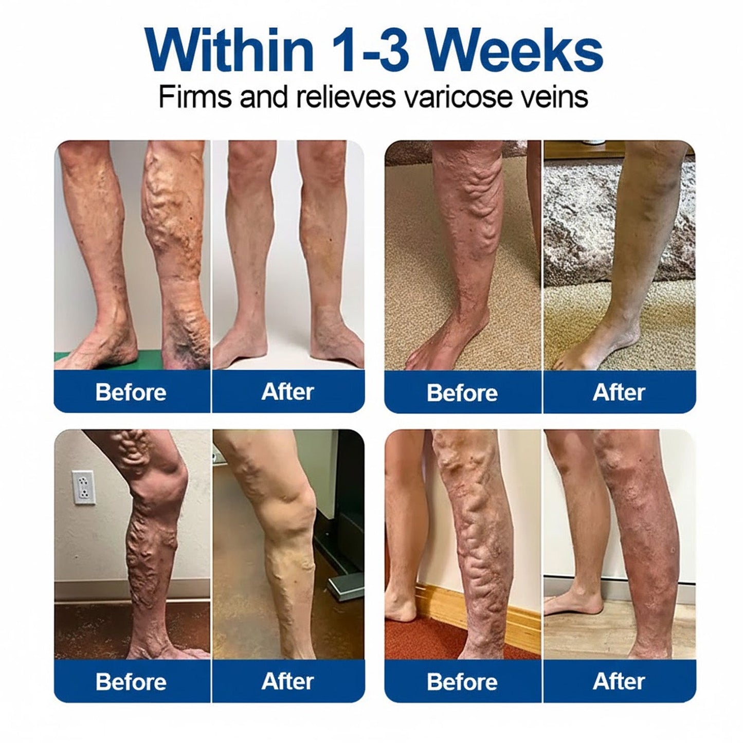 🇿🇦👨‍⚕️📌GFOUK® VeinEase Microneedle Care Patch⚡Instant Relief, Long-Term Results