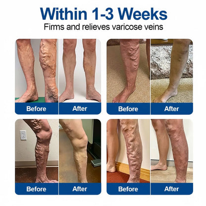 🇿🇦👨‍⚕️💥GFOUK® VeinEase Microneedle Care Patch⚡Instant Relief, Long-Term Results